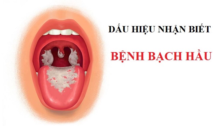  Những điều cần biết về Bệnh Bạch Hầu